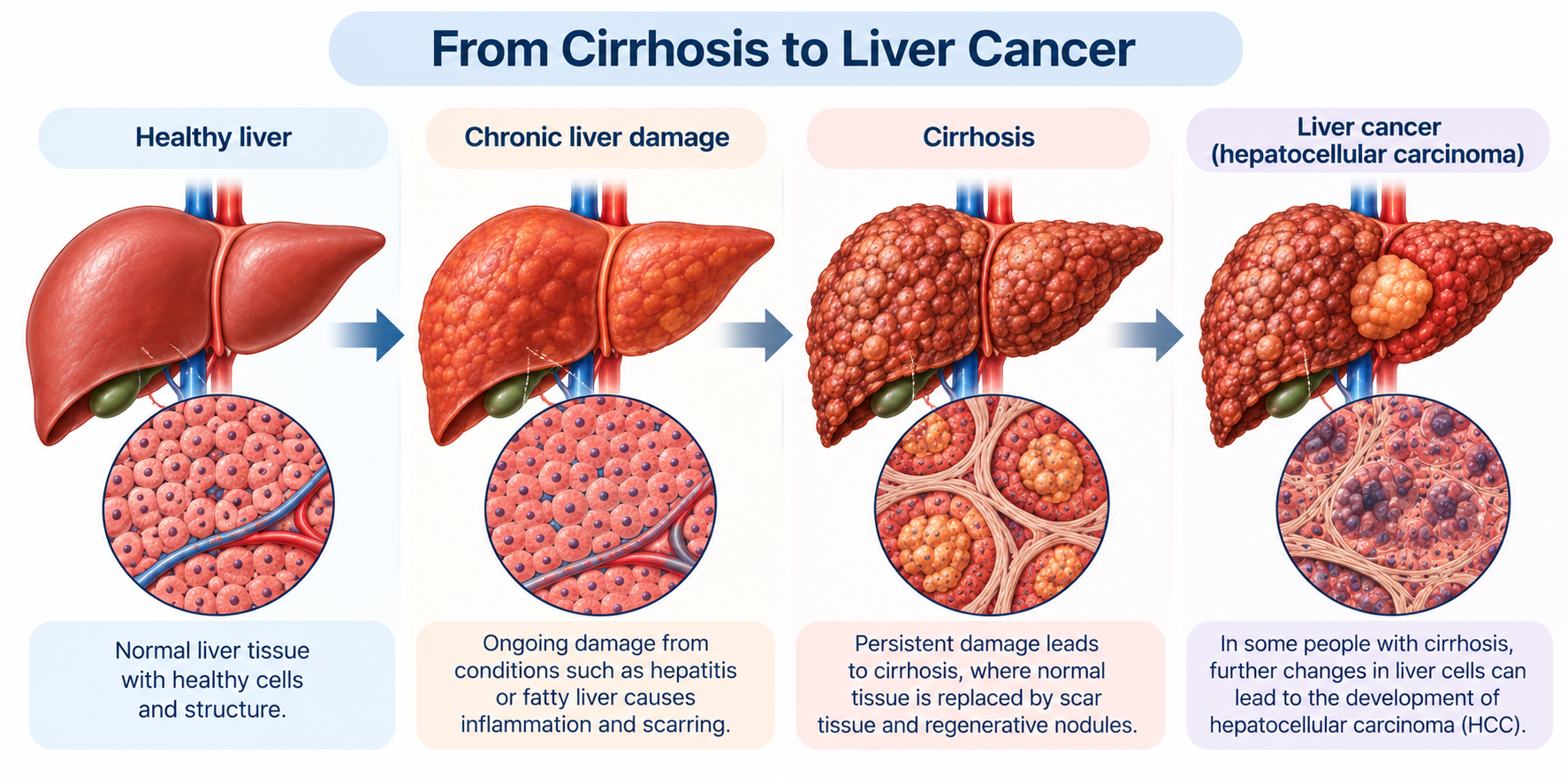 Cirrhosis to Liver Cancer Progression Singapore