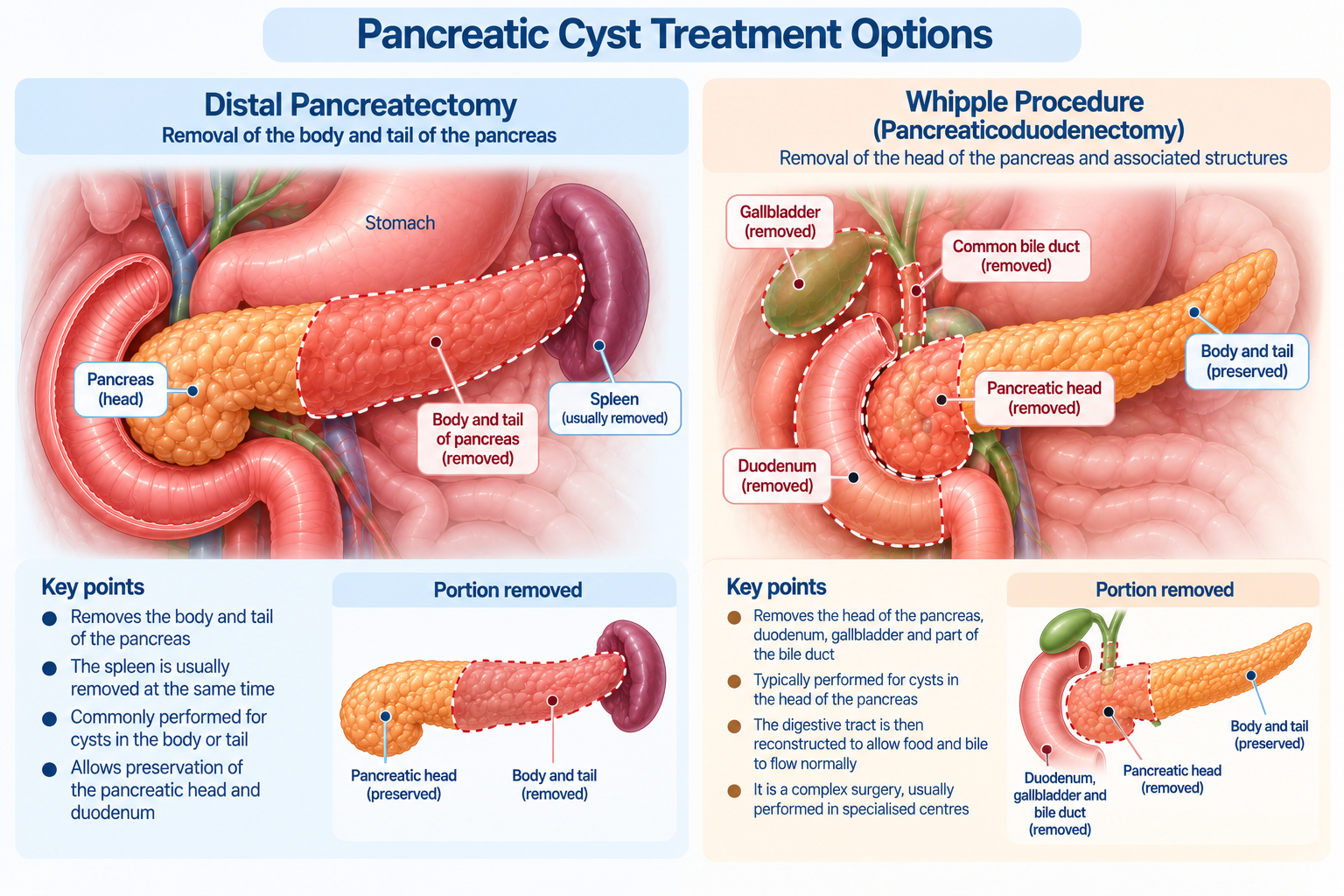 Pancreatic Cyst Surgical Treatments Singapore