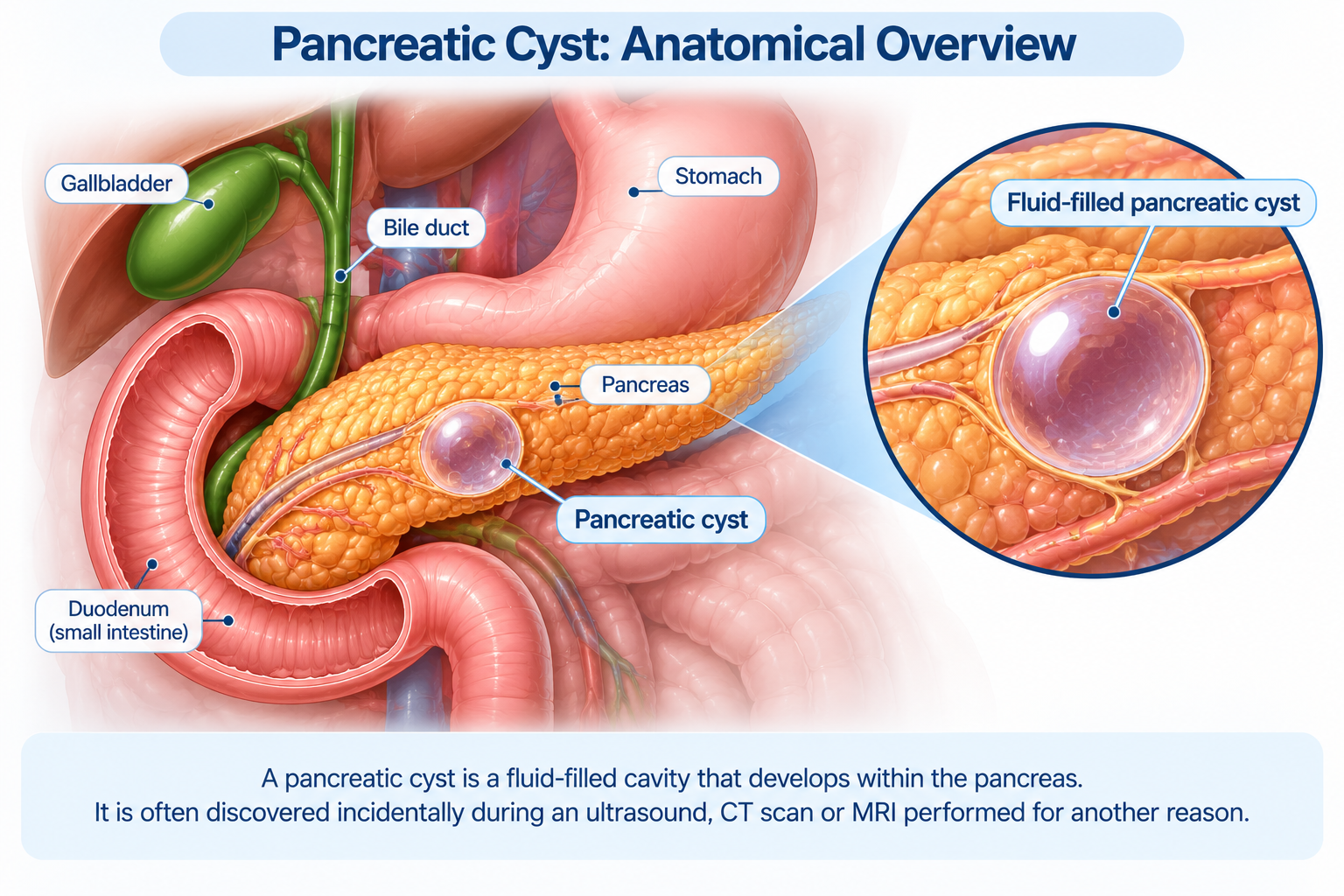 Pancreatic Cyst Singapore