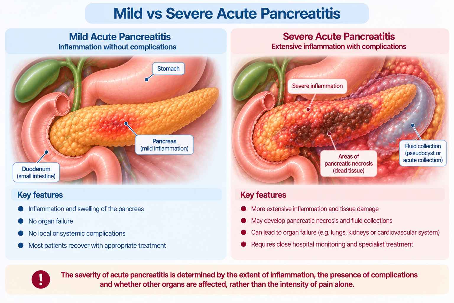 Mild Vs Severe Pancreatitis Singapore
