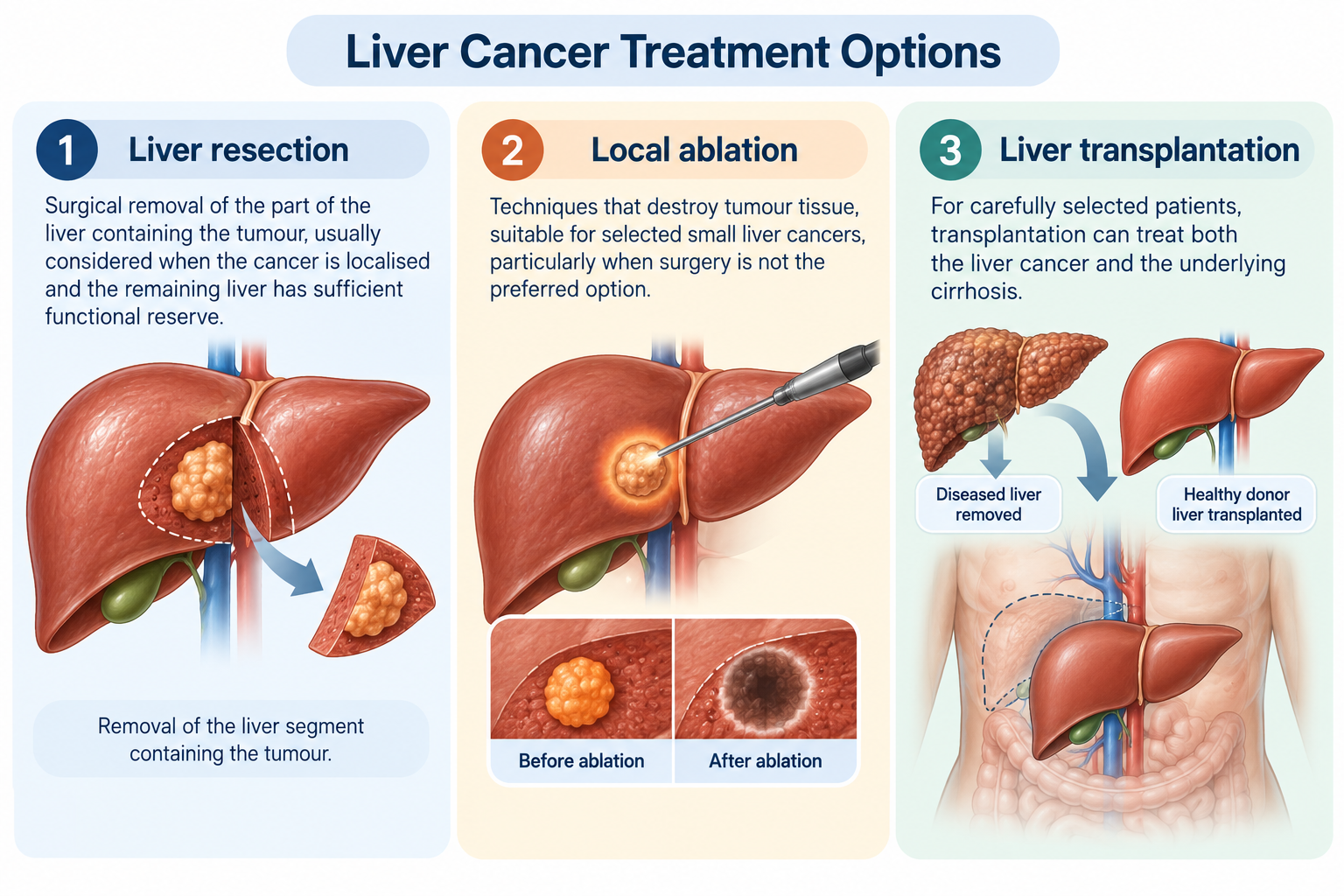 Liver Cancer Treatment Options Singapore